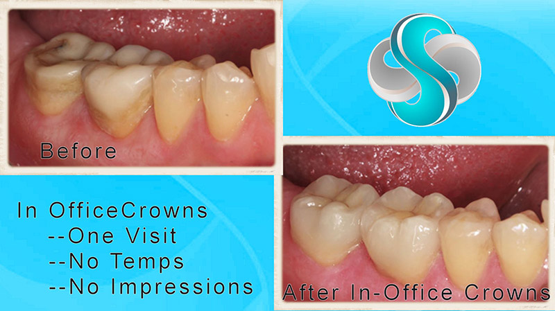 CEREC Before and After