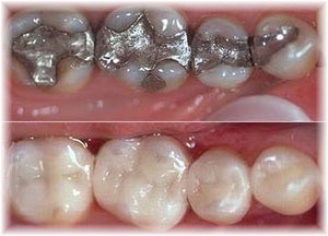Cerec