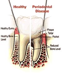 From Healthy to Diseased Gum Tissue