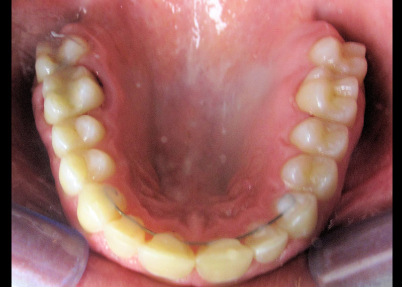 Braces on Adult to Stabilize Bite After
