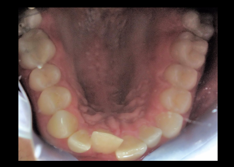 Braces on Adult to Stabilize Bite Before