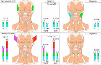 How Does a TENS Unit Help With TMJ (Temporomandibular Joint) Pain?