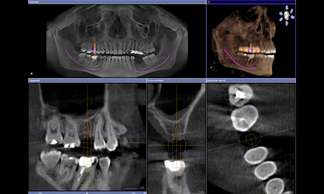 pi-galileos-implant-software-panorama-646-01